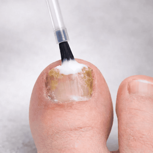 Sugar, Diabetes, and “Nail Fungus”: What We Know (and Don’t) About Diet and Common Superficial Fungal Infections