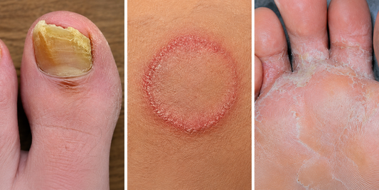 Nail Fungus, Ringworm, Athlete's Foot, or Jock Itch? Here's How to Tell the Difference