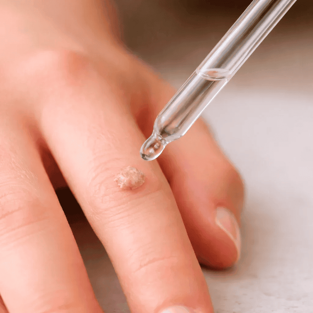 WART TREATMENTS - Sisquoc Healthcare