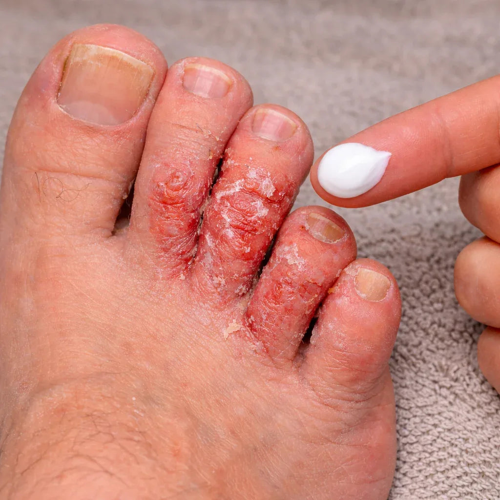 ATHLETES FOOT TREATMENTS - Sisquoc Healthcare
