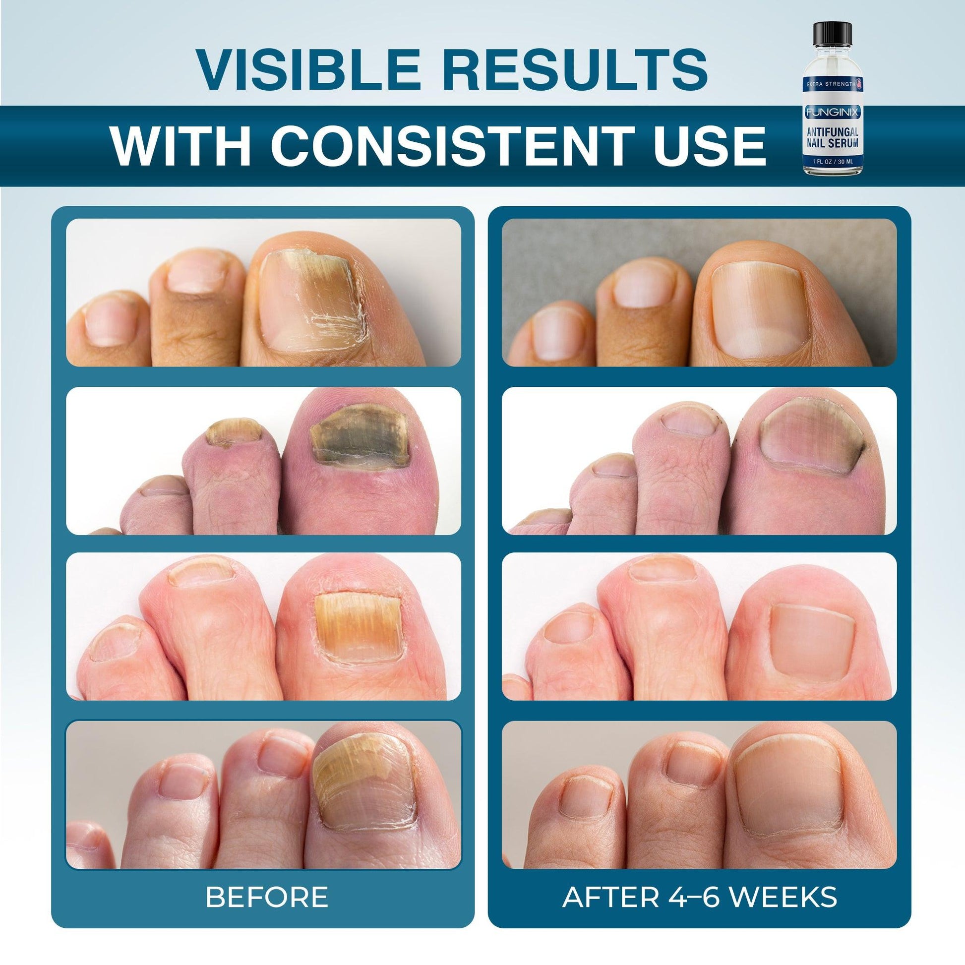 FUNGINIX - Extra Strength Toenail Fungus Treatment.