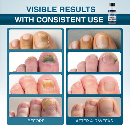 FUNGINIX - Extra Strength Toenail Fungus Treatment.