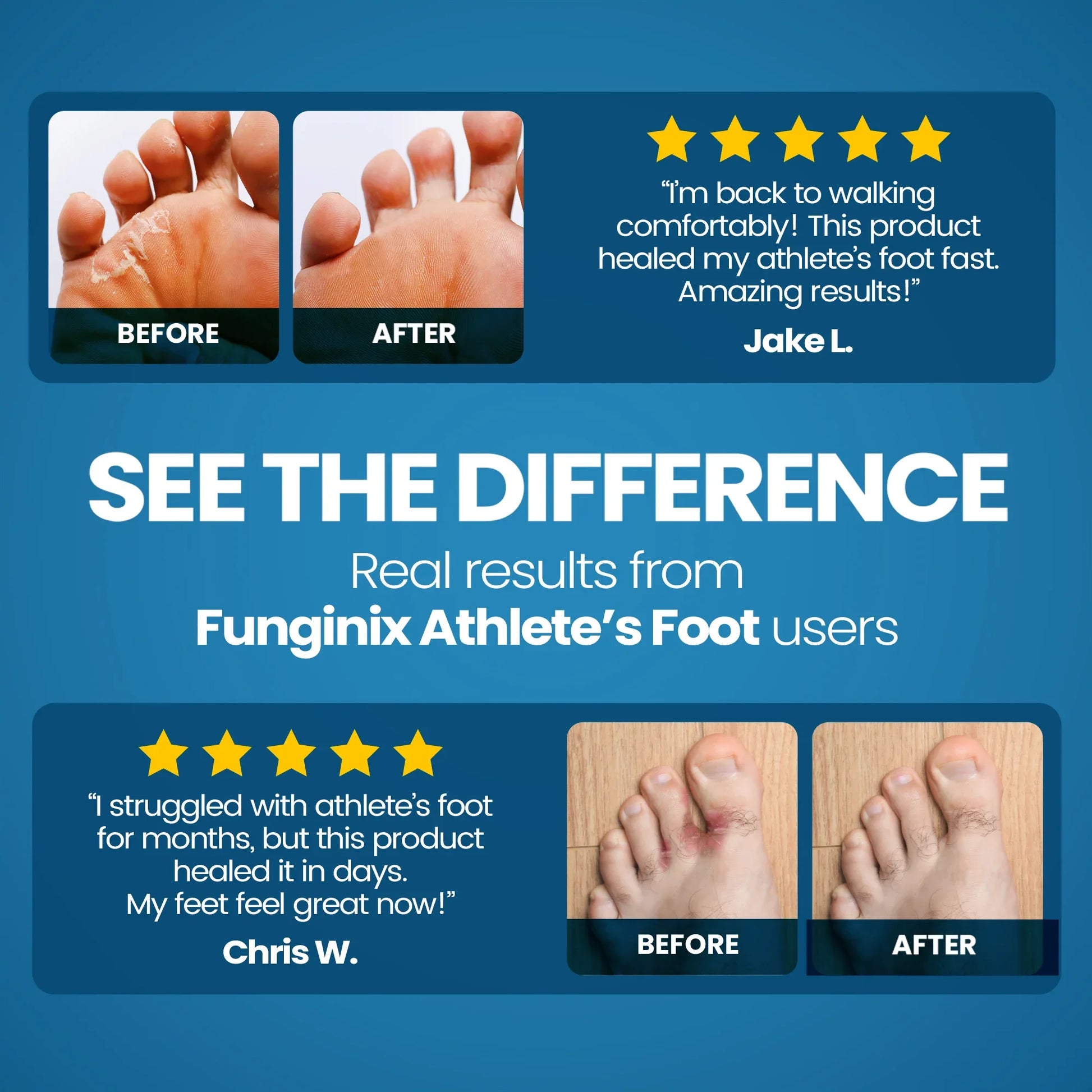 FUNGINIX AF Athletes Foot Cream - Topical Anti-Fungal Treatment, Eliminates Athlete's Foot Infections, Safe & Effective (1 Ounce) - Sisquoc Healthcare