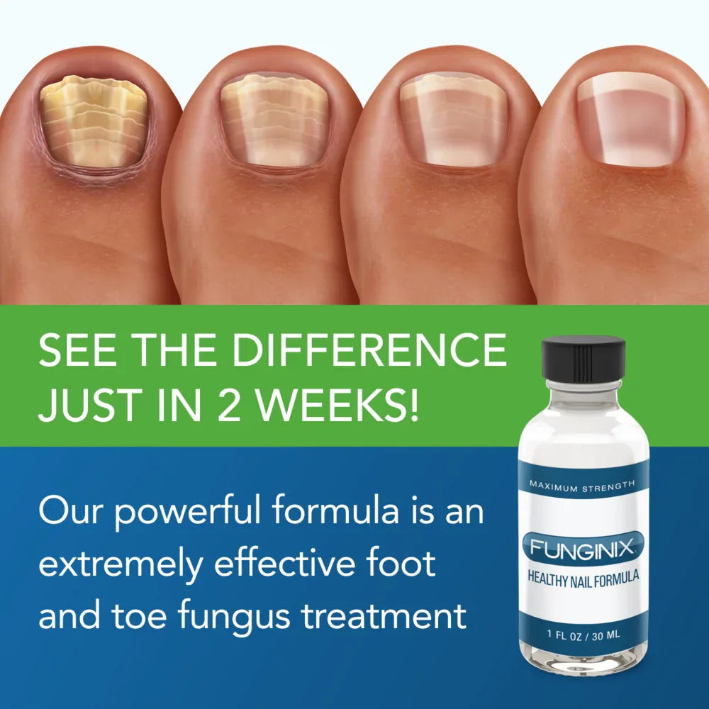 FUNGINIX Toenail Fungus Treatment Extra Strength - Antifungal Nail Treatment With Undecylenic Acid & Tea Tree Oil - Sisquoc Healthcare