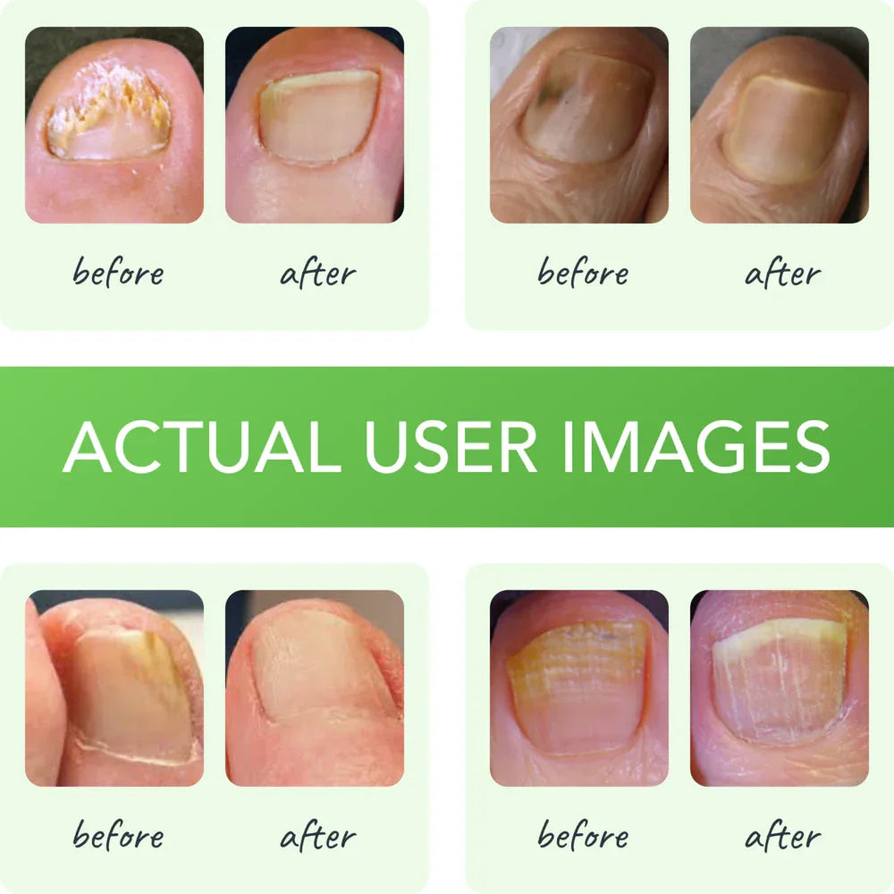 FUNGINIX Toenail Fungus Treatment Extra Strength - Antifungal Nail Treatment With Undecylenic Acid & Tea Tree Oil - Sisquoc Healthcare